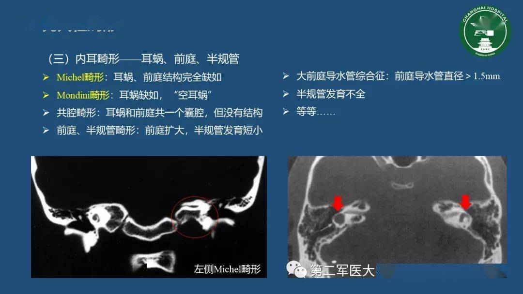 颞骨断层解剖与CT三维重建 医学三维分析的临床价值